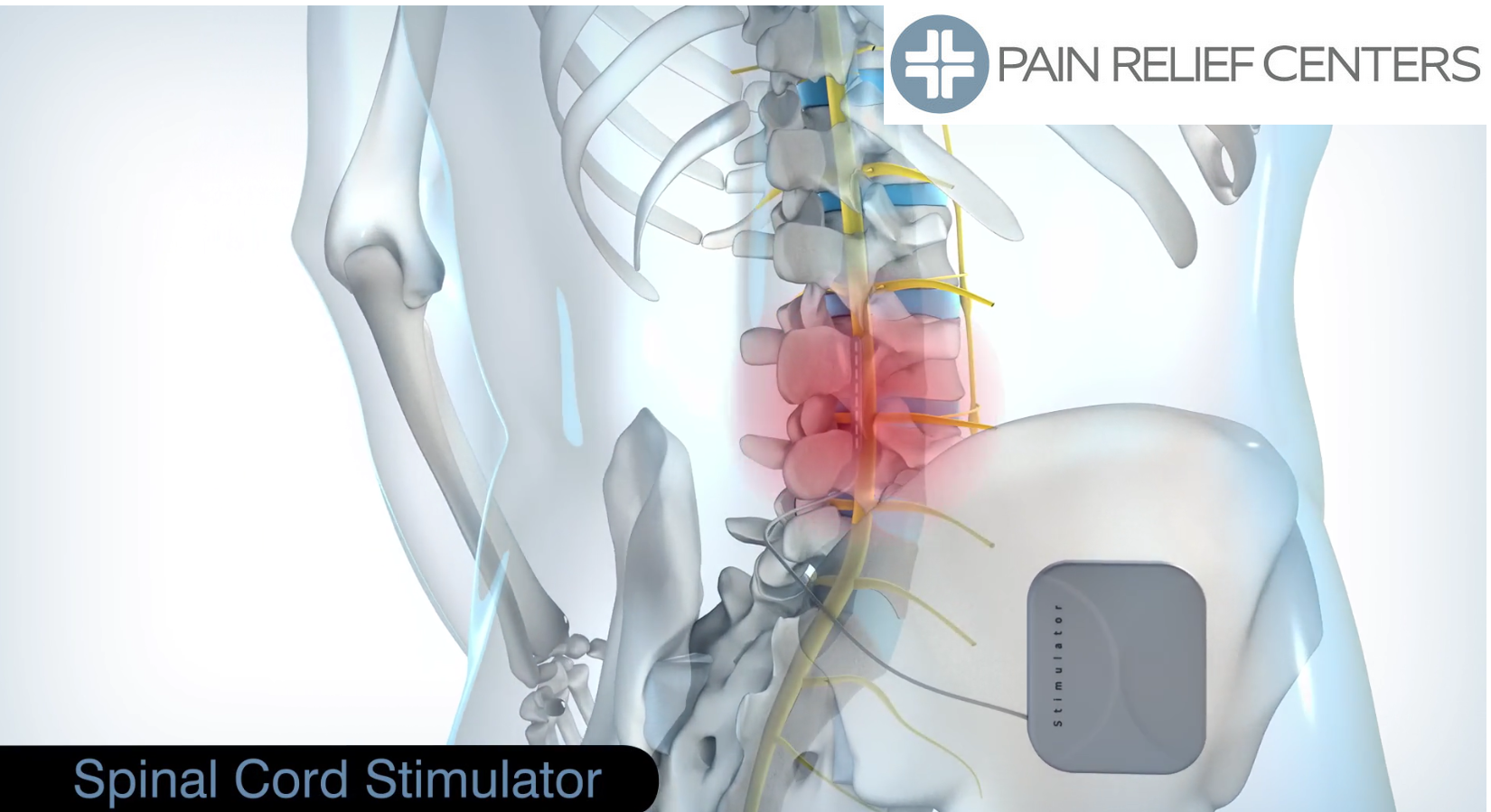 Spinal Cord Stimulator